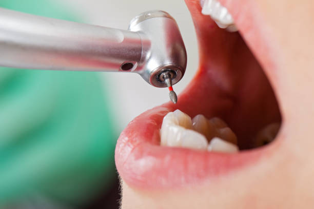Best Emergency Dentist for Lost Fillings or Crowns in Bayview, CA